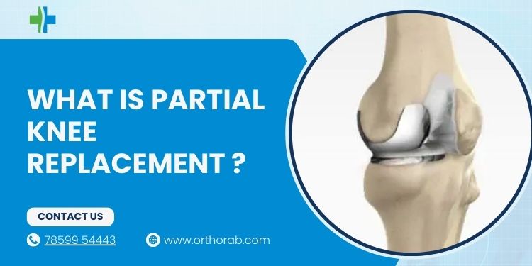 Partial Knee Replacement